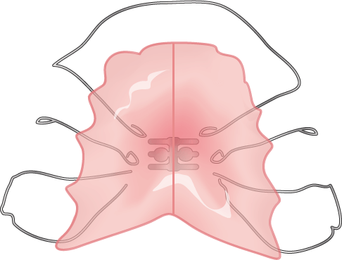 上顎を拡げる床矯正装置