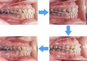 矯正治療中の歯の動き
