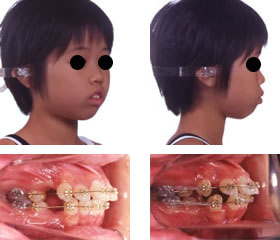 抜歯の治療例