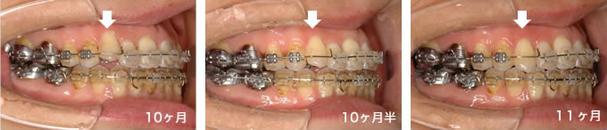 動かない歯を動かす