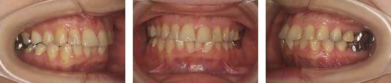 矯正治療を始める前の歯並び
