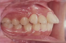 永久歯が生え揃う前の矯正治療例