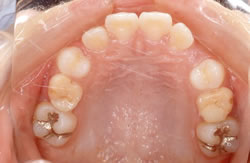 永久歯が生え揃う前の矯正治療例