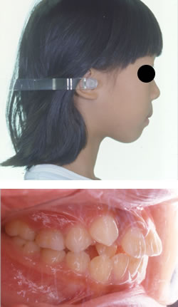 永久歯が生え揃ってからの矯正治療例　