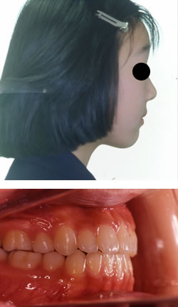 永久歯が生え揃ってからの矯正治療例　