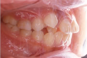 歯並びの一般的なお悩み