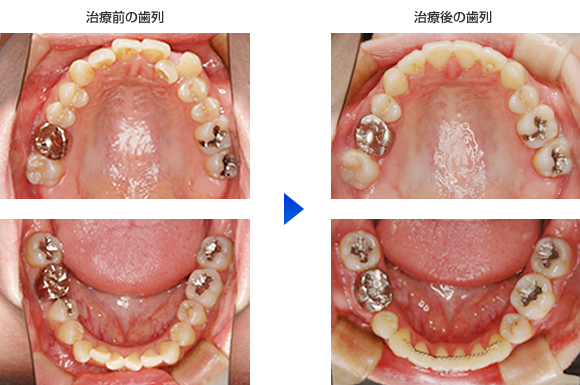 治療前、後の歯列