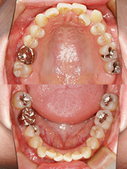 治療前の上下顎