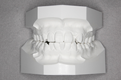治療前の歯の模型