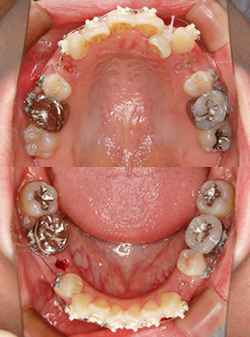 上下顎に矯正装置装着